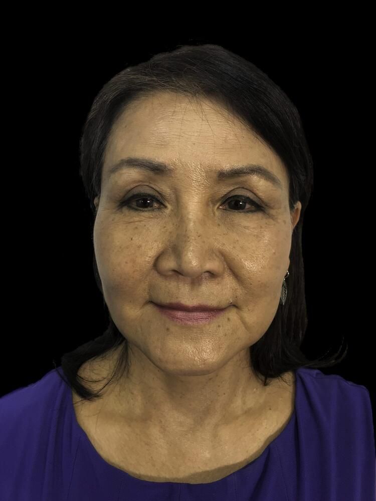 Facial Fat Transfer Before & After