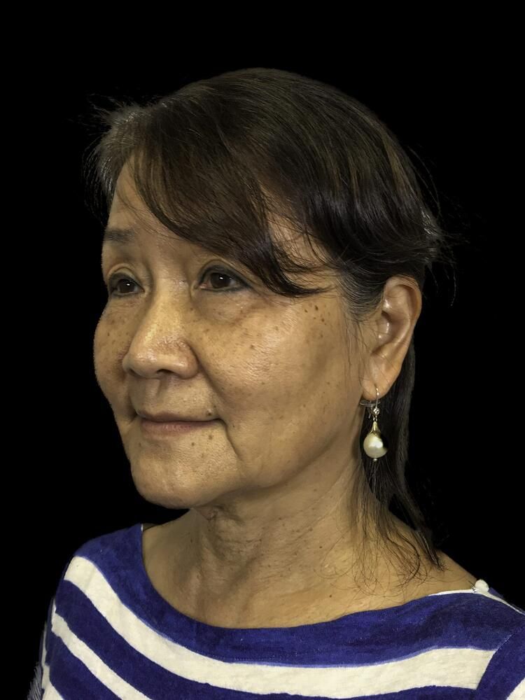 Facial Fat Transfer Before & After