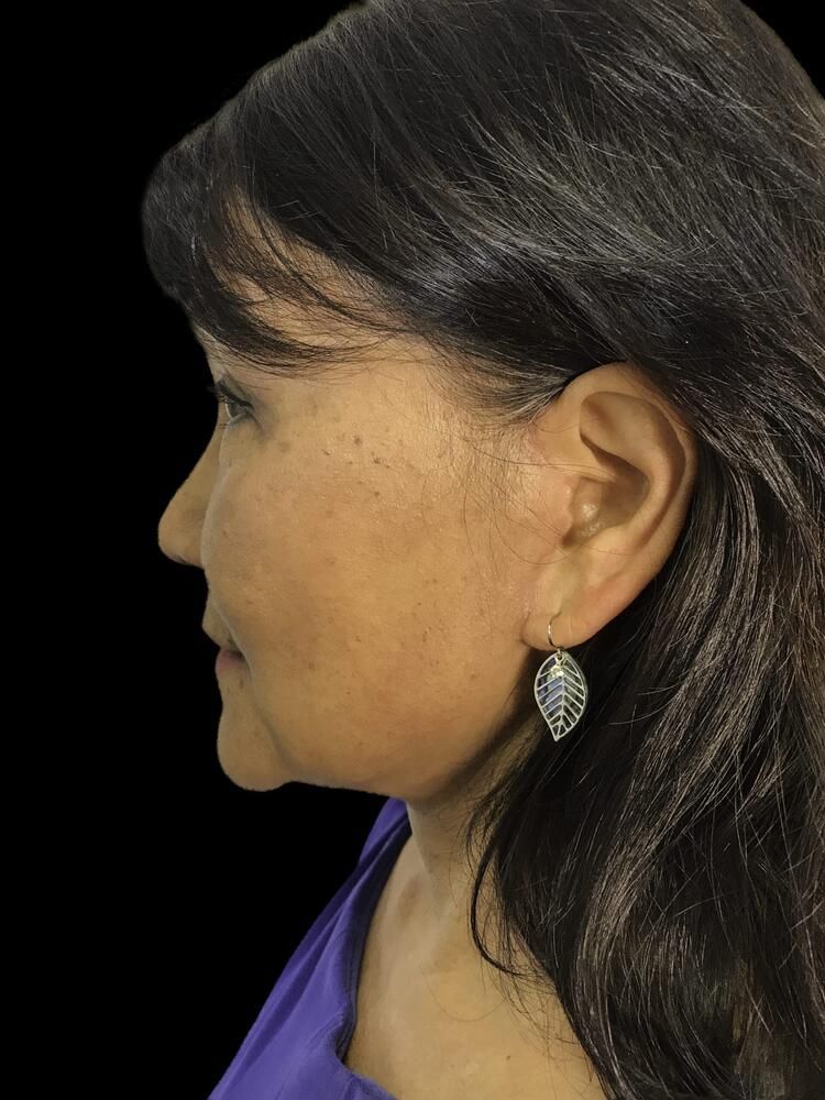 Facial Fat Transfer Before & After