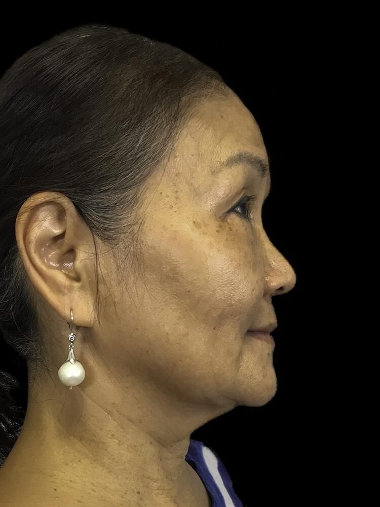 Facial Fat Transfer Before & After