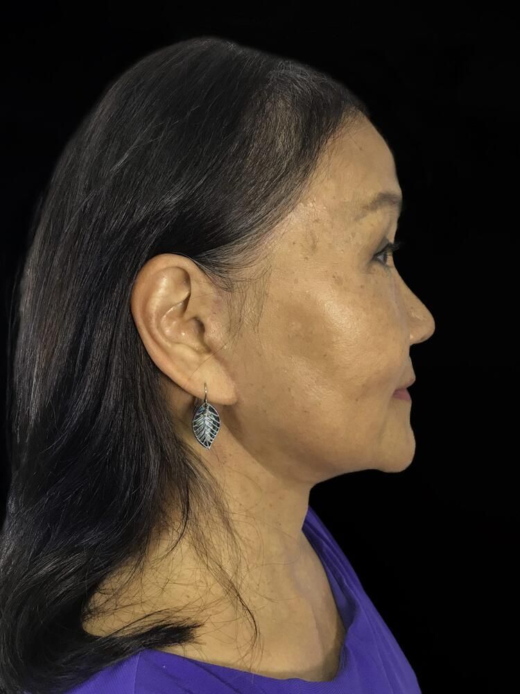 Facial Fat Transfer Before & After