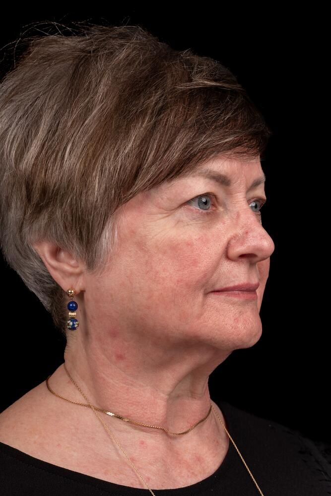 Facial Fat Transfer Before & After