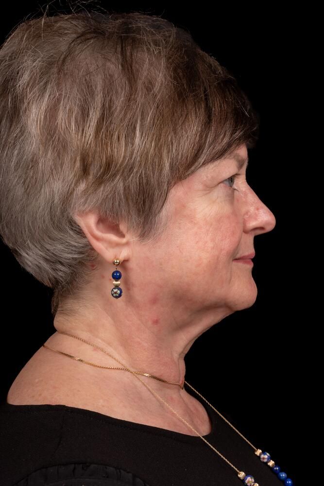 Facial Fat Transfer Before & After