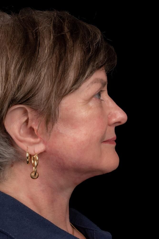 Facial Fat Transfer Before & After