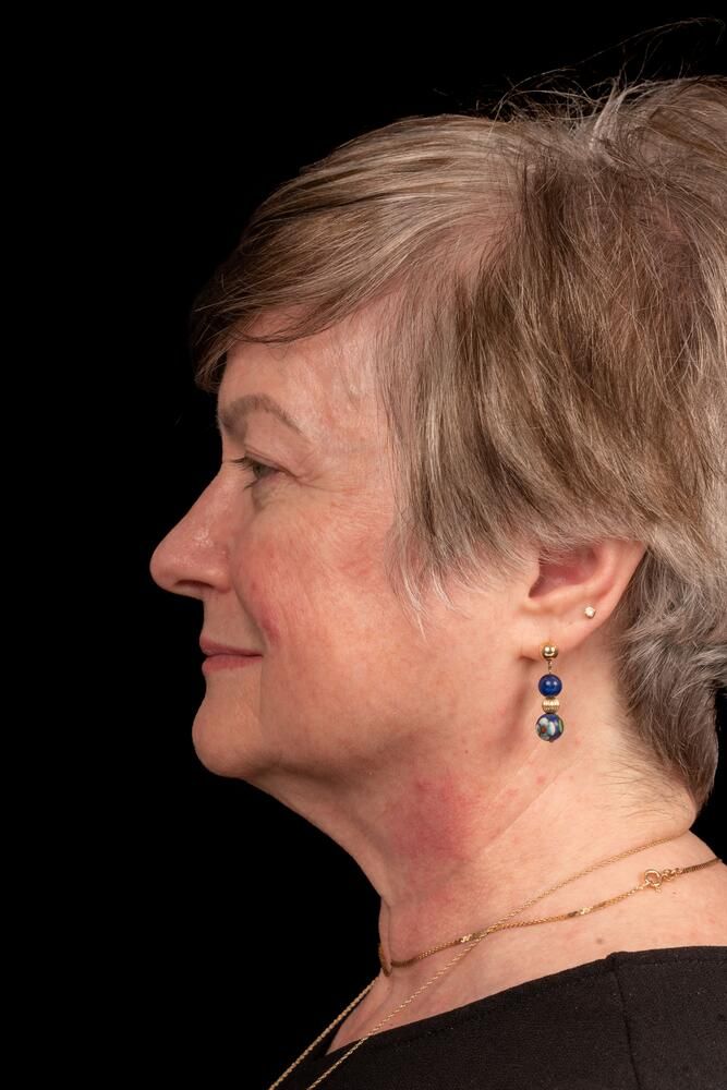 Facial Fat Transfer Before & After