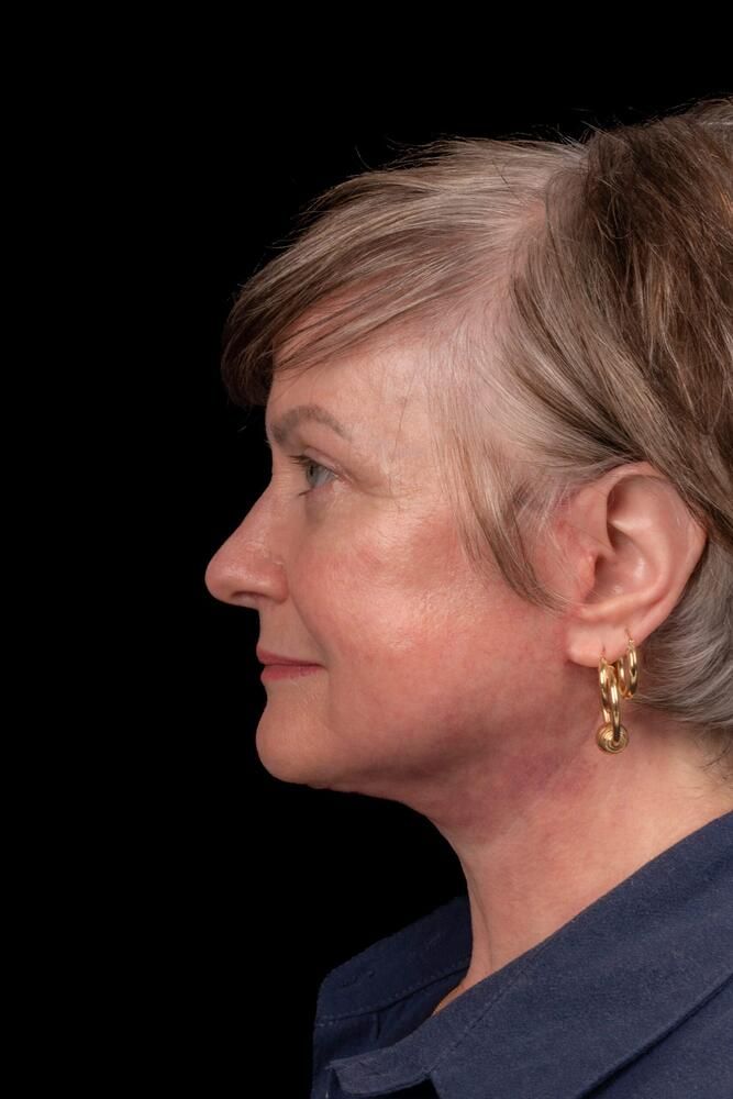 Facial Fat Transfer Before & After