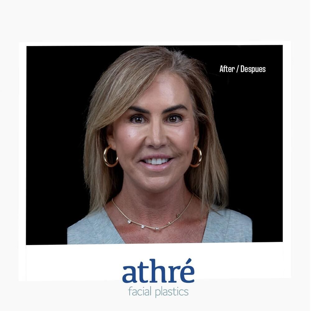 Facial Fat Transfer Before & After