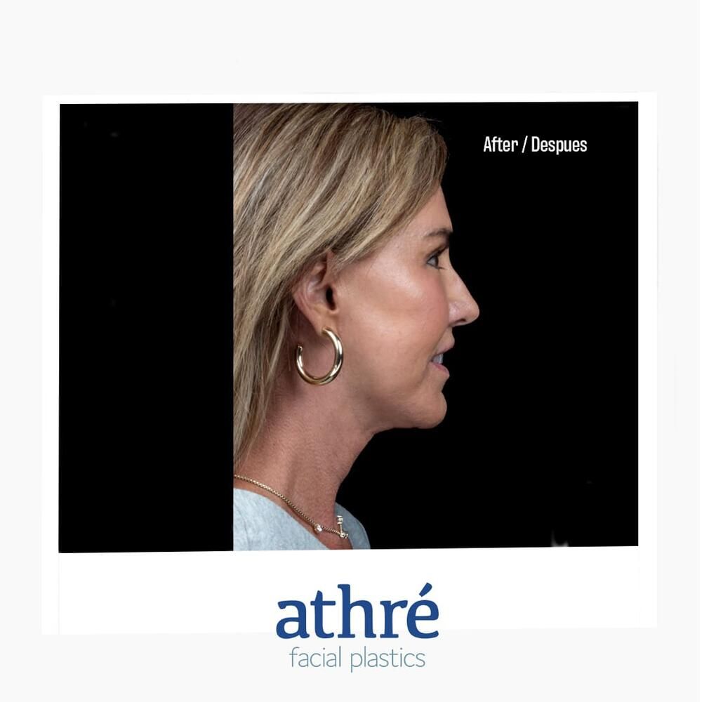 Facial Fat Transfer Before & After