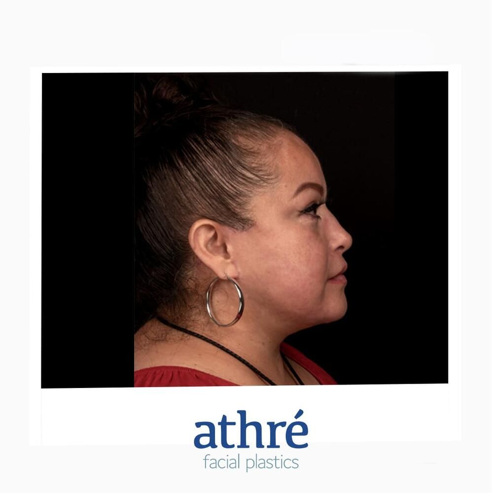 Facial Fat Transfer Before & After