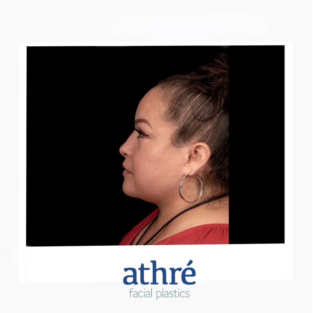 Facial Fat Transfer Before & After