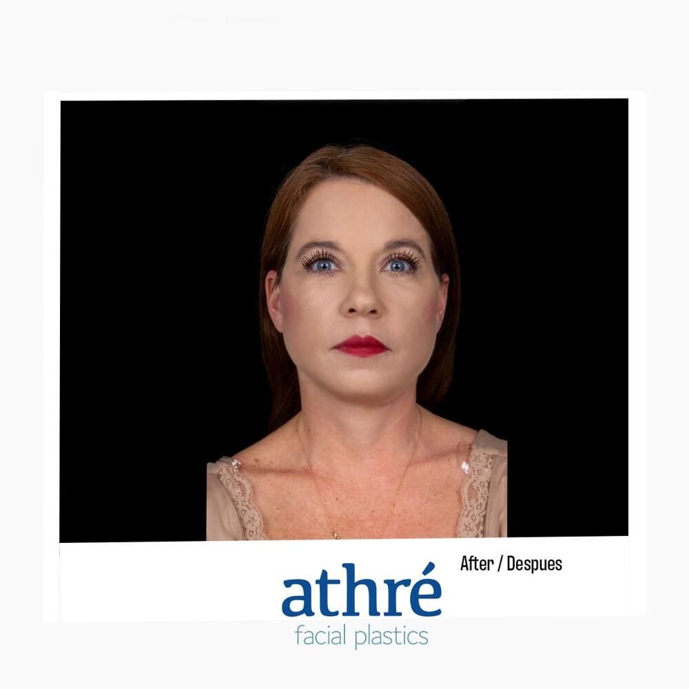 Facial Fat Transfer Before & After