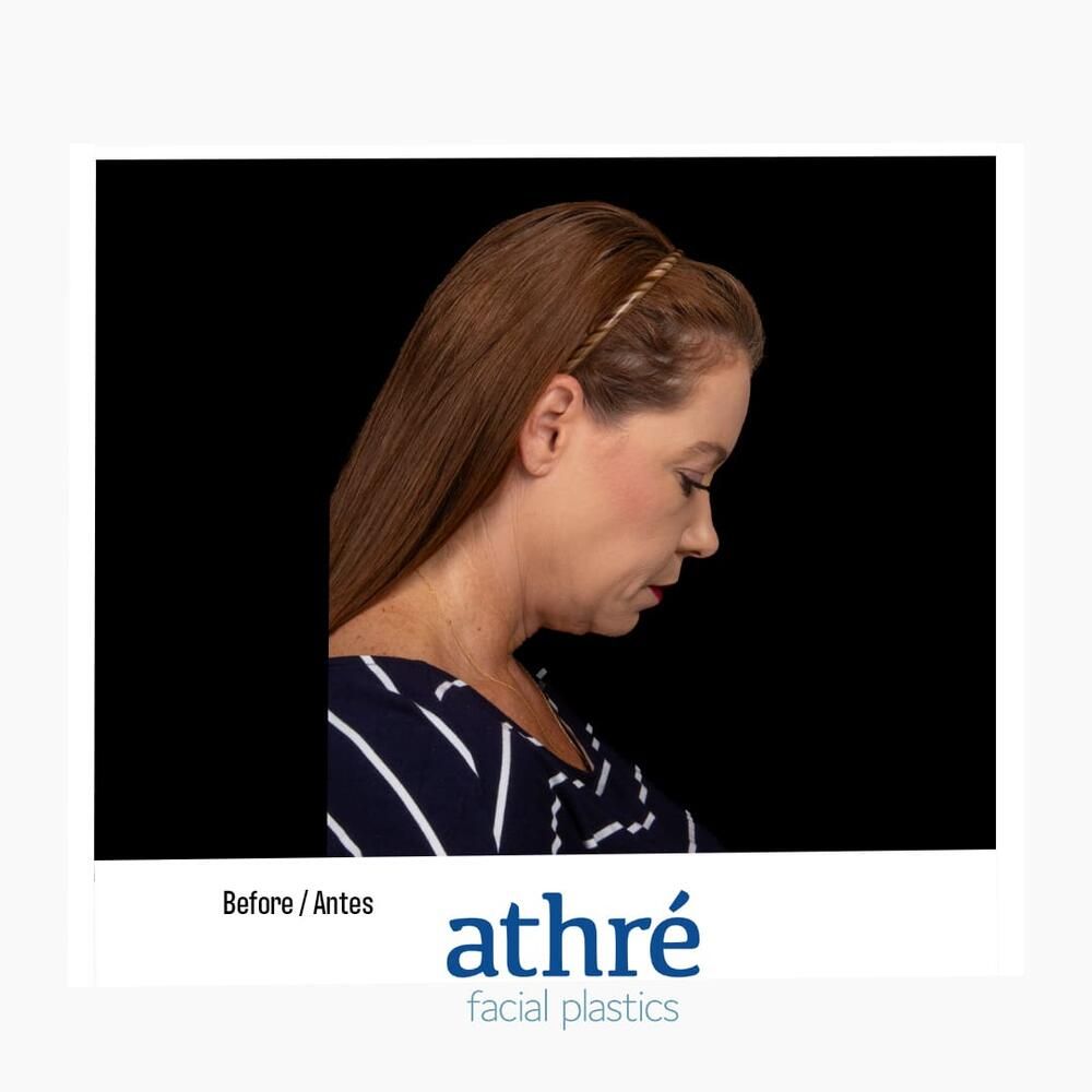 Facial Fat Transfer Before & After