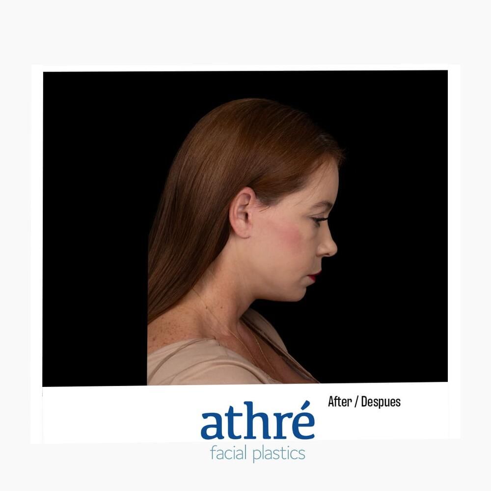 Facial Fat Transfer Before & After