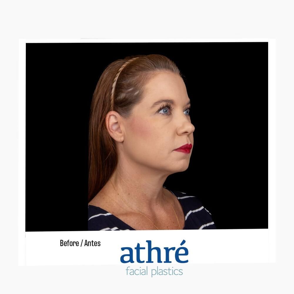 Facial Fat Transfer Before & After