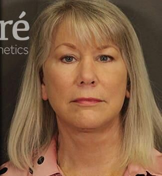 Brow Lift Before & After