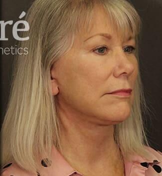 Brow Lift Before & After