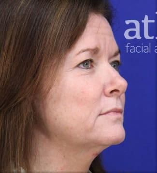 Brow Lift Before & After