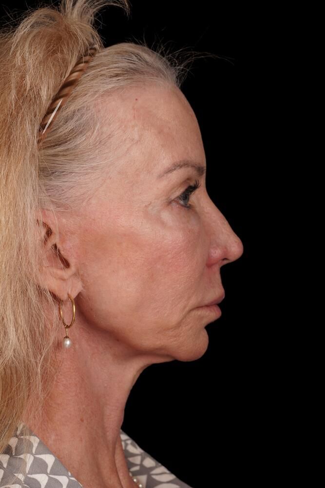 Brow Lift Before & After