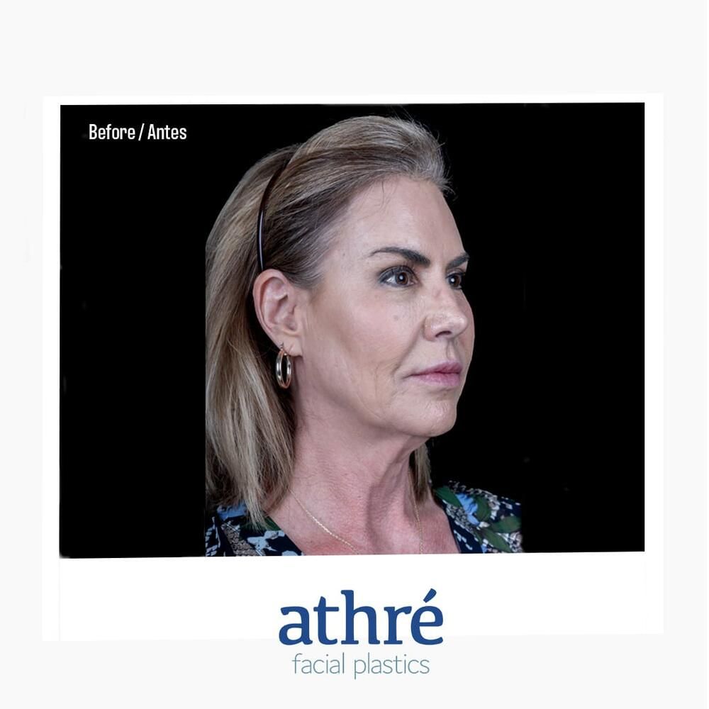 Brow Lift Before & After