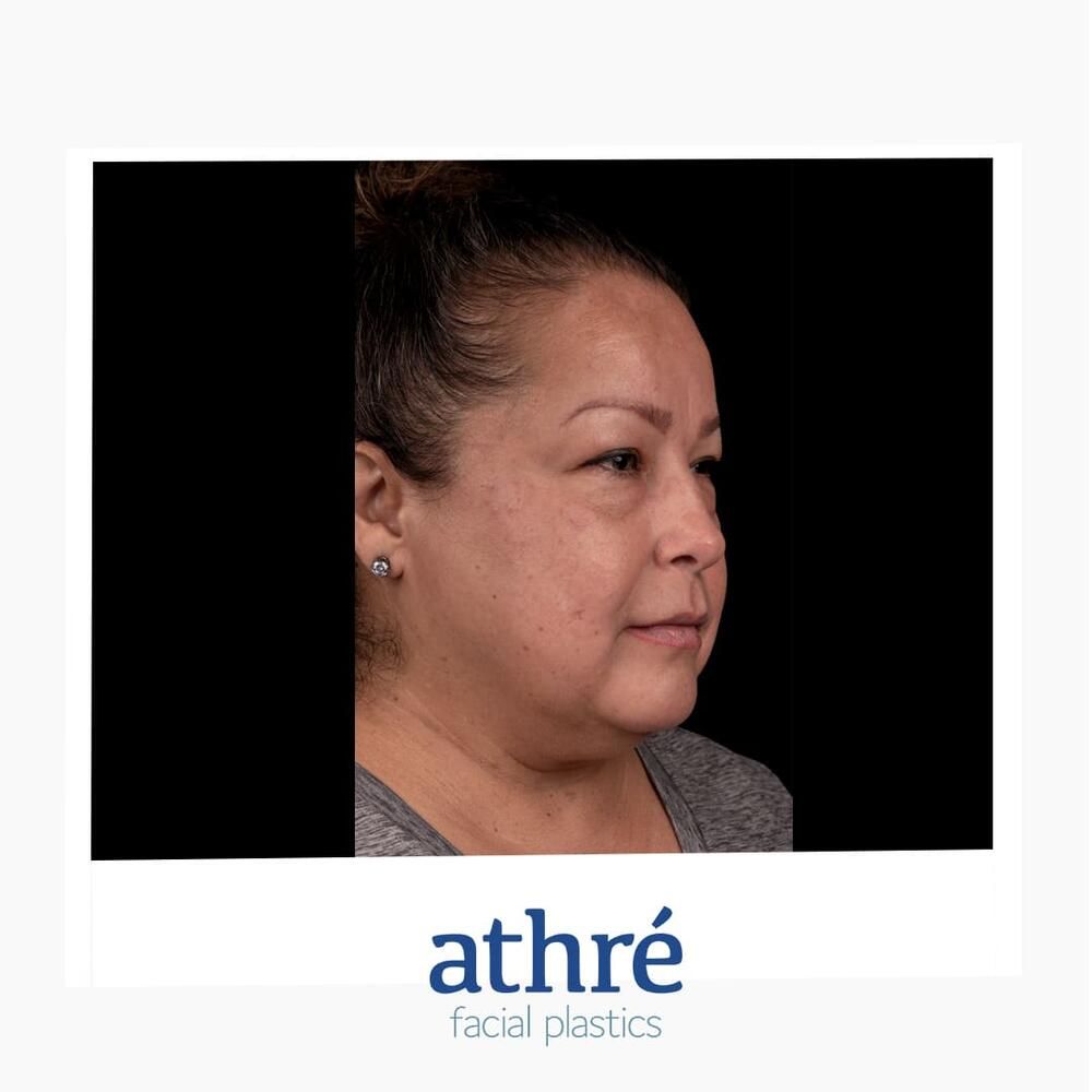 Brow Lift Before & After