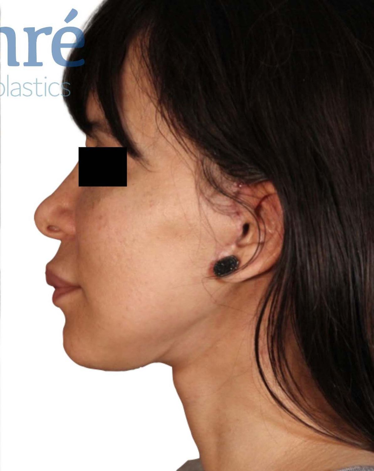 Lip Lift Before & After