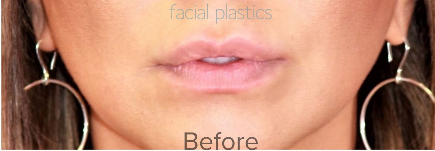 Lip Lift Before & After