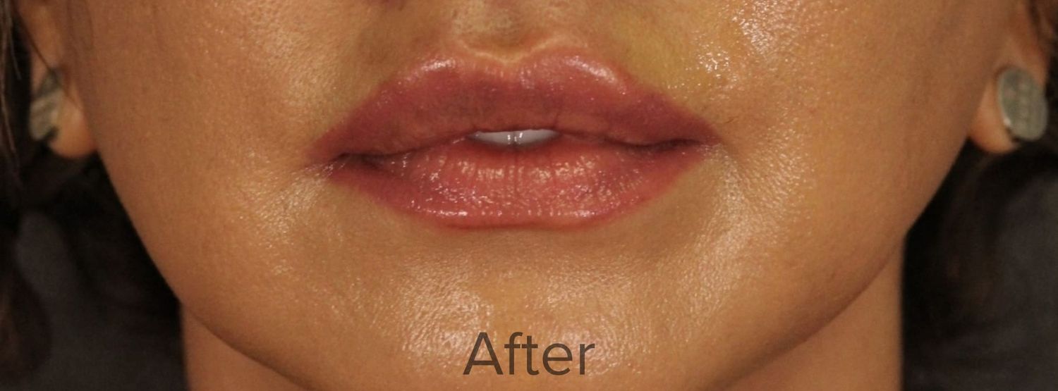 Lip Lift Before & After