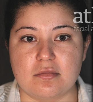 Lip Lift Before & After