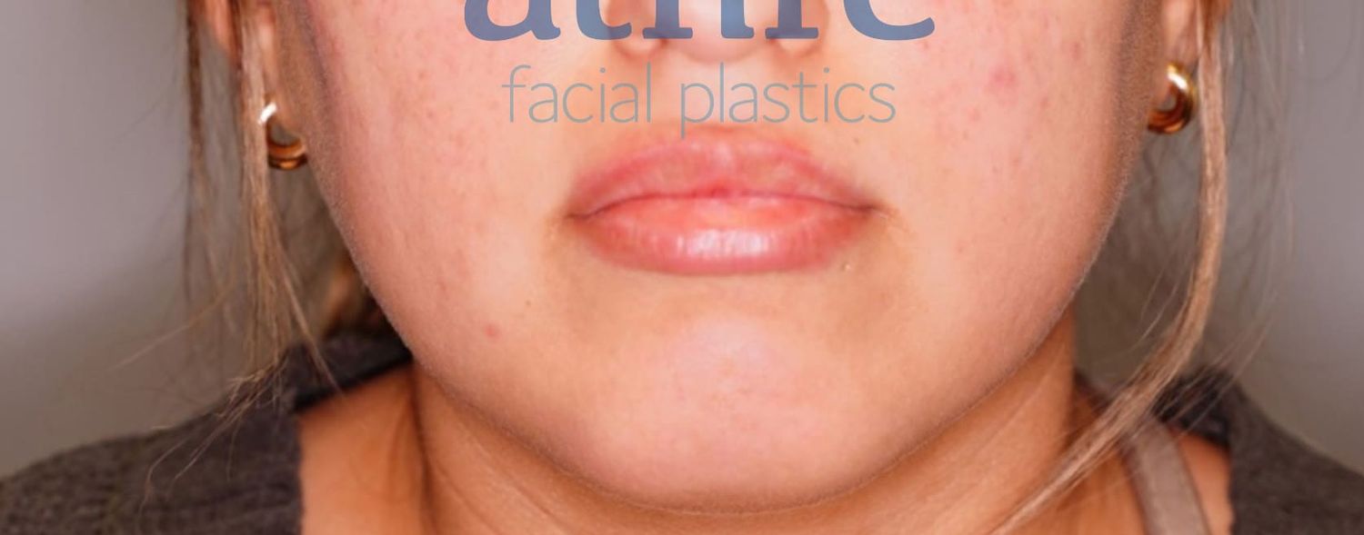 Lip Lift Before & After