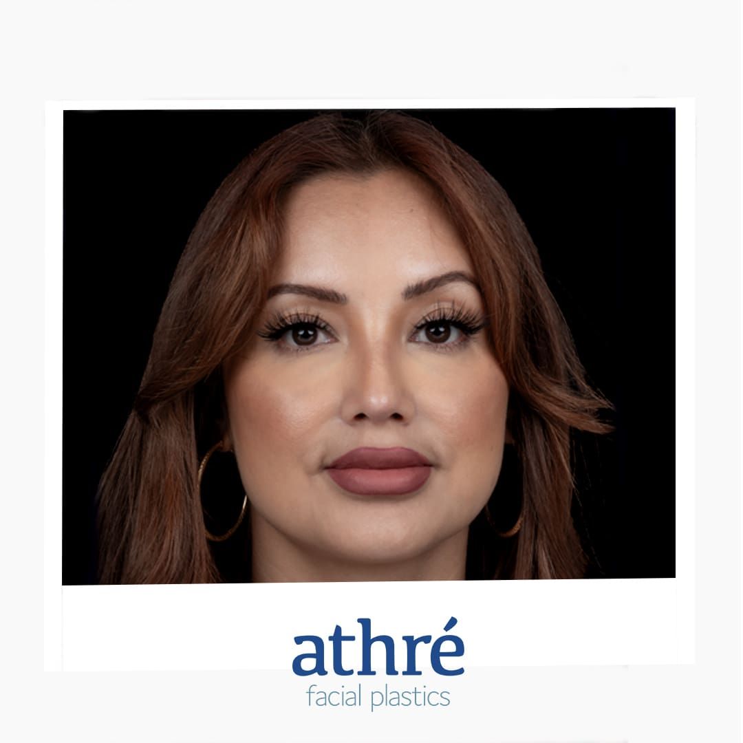 Lip Lift Before & After