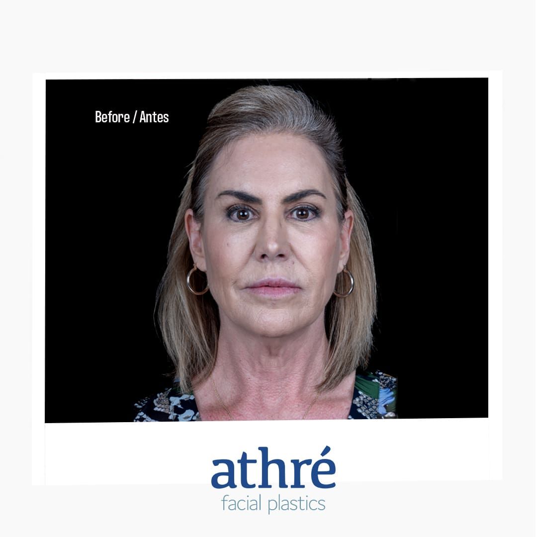 Lip Lift Before & After