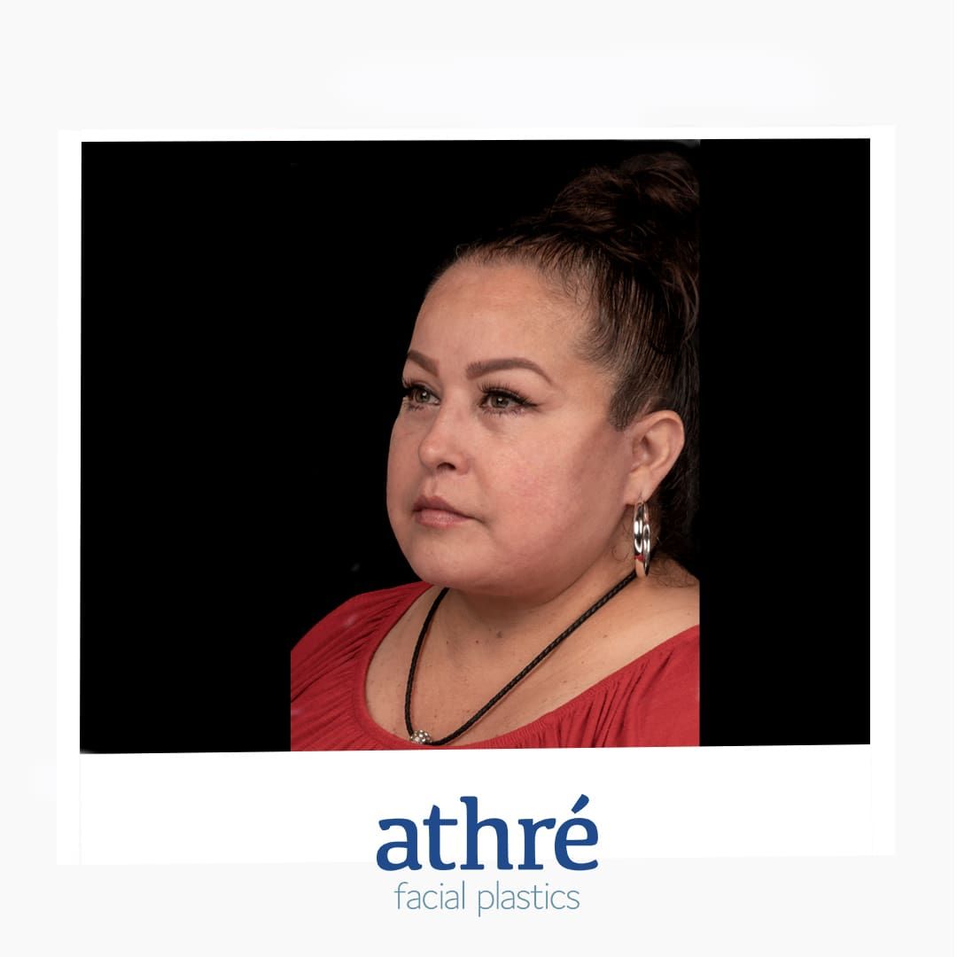 Lip Lift Before & After