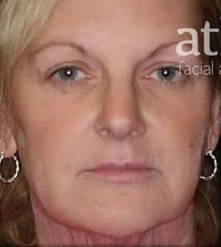 Skin Resurfacing Before & After
