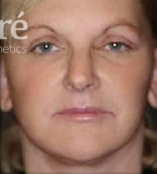 Skin Resurfacing Before & After