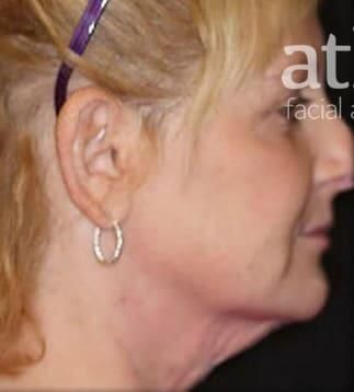 Skin Resurfacing Before & After