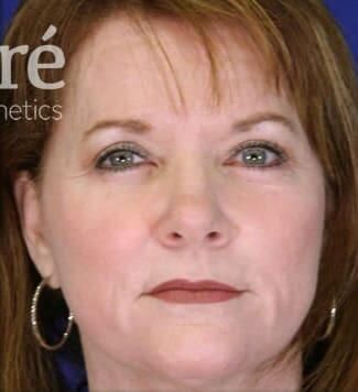 Skin Resurfacing Before & After