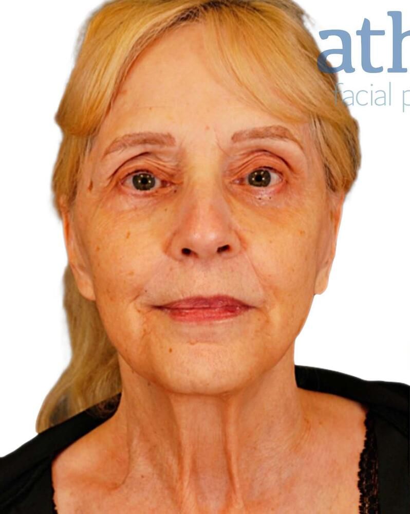 Skin Resurfacing Before & After