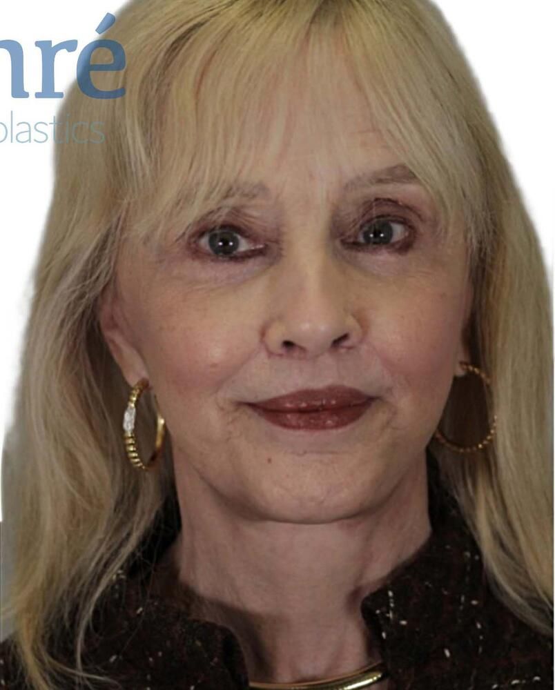 Skin Resurfacing Before & After