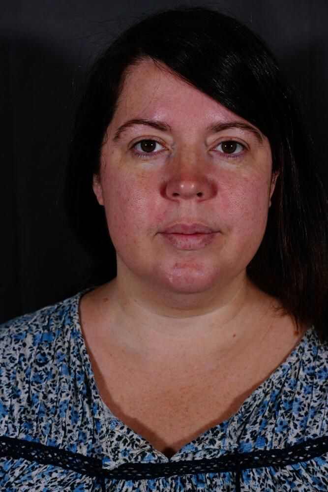 Skin Resurfacing Before & After