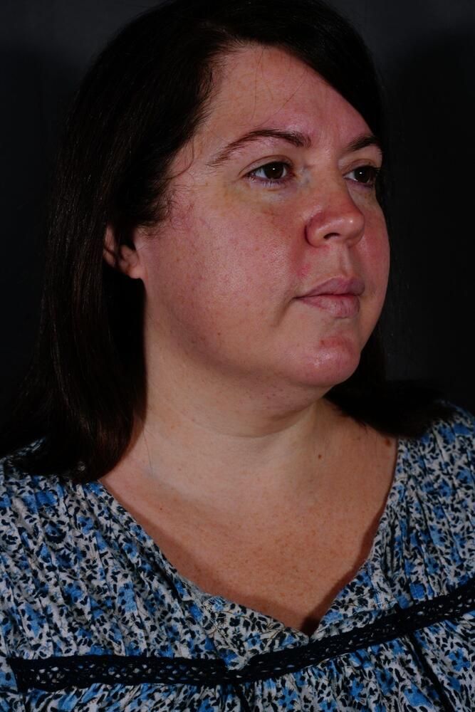 Skin Resurfacing Before & After