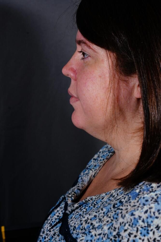 Skin Resurfacing Before & After