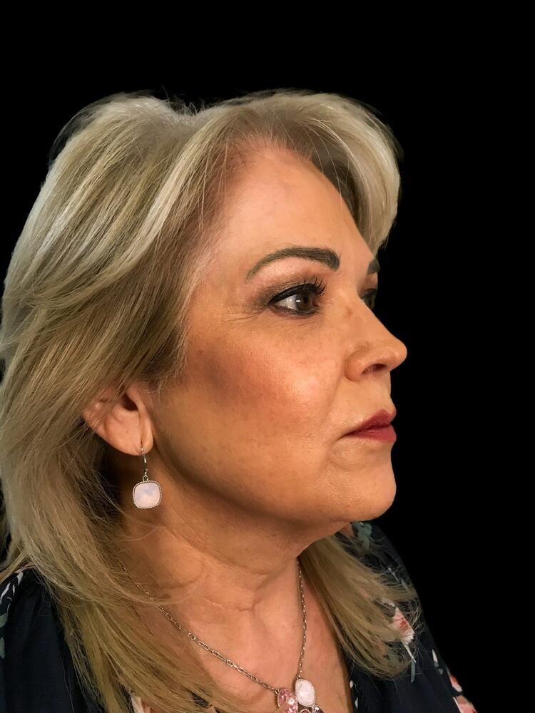 Skin Resurfacing Before & After