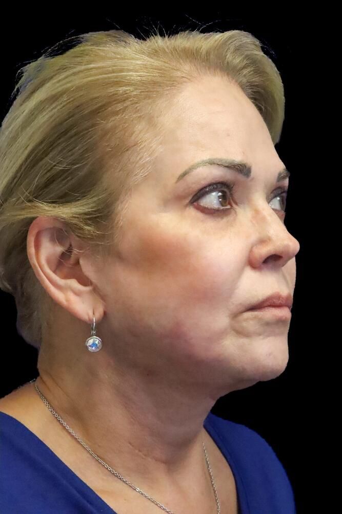 Skin Resurfacing Before & After