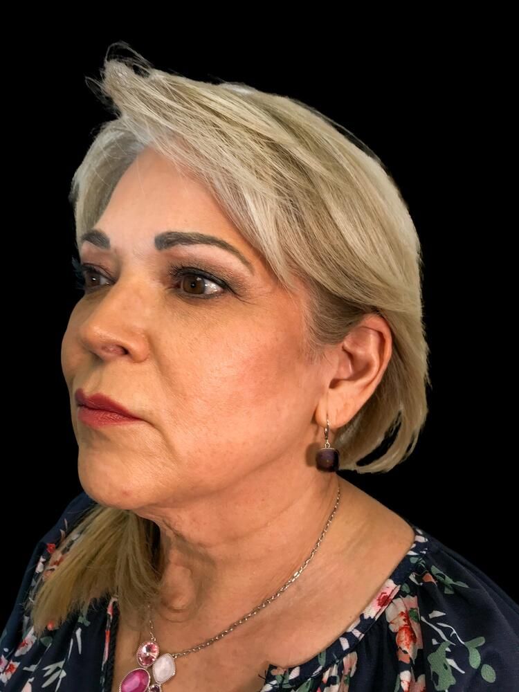 Skin Resurfacing Before & After