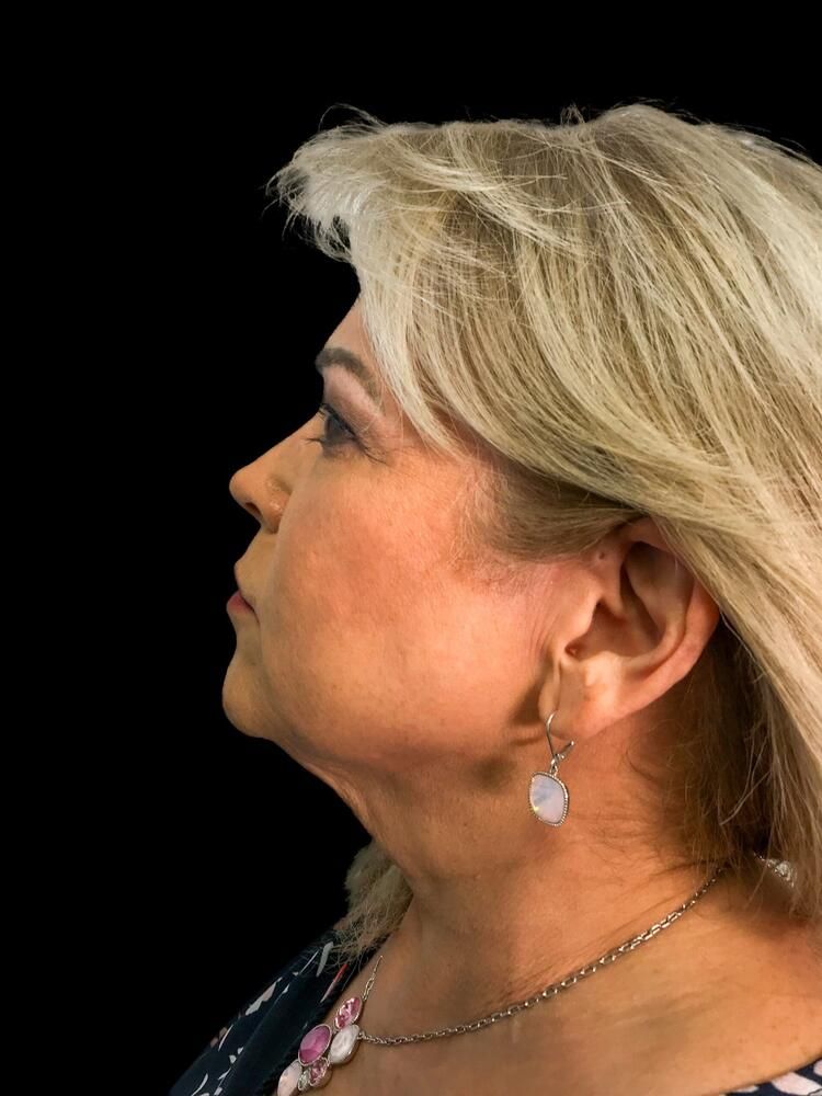 Skin Resurfacing Before & After