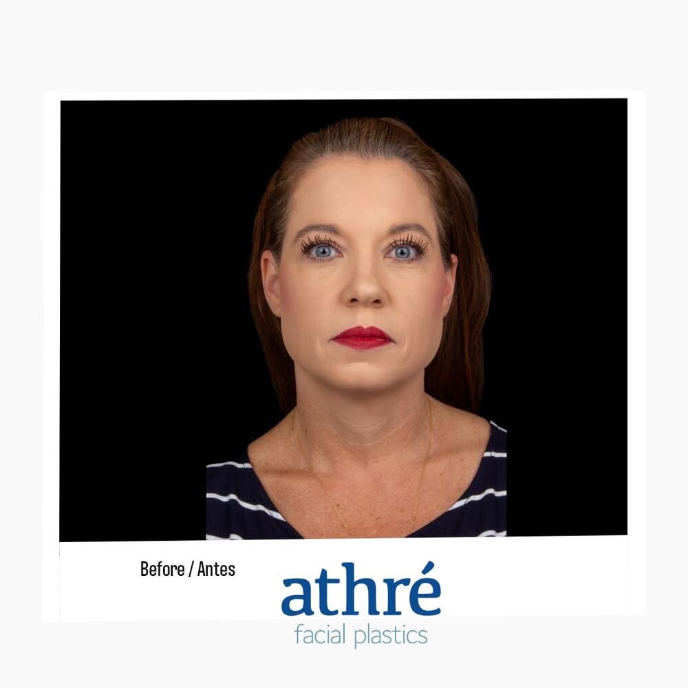 Skin Resurfacing Before & After