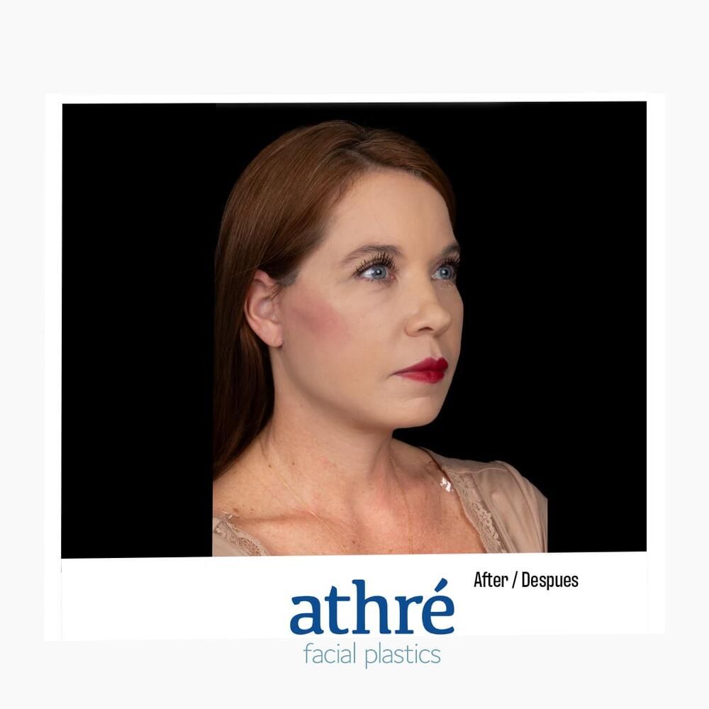 Skin Resurfacing Before & After